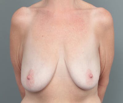 Breast Lift Before & After Gallery - Patient 655979 - Image 1 - Scott Chapin, MD
