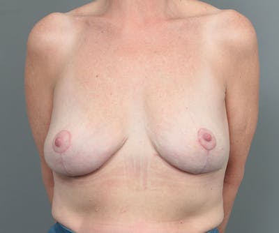 Breast Lift Before & After Gallery - Patient 655979 - Image 2 - Scott Chapin, MD