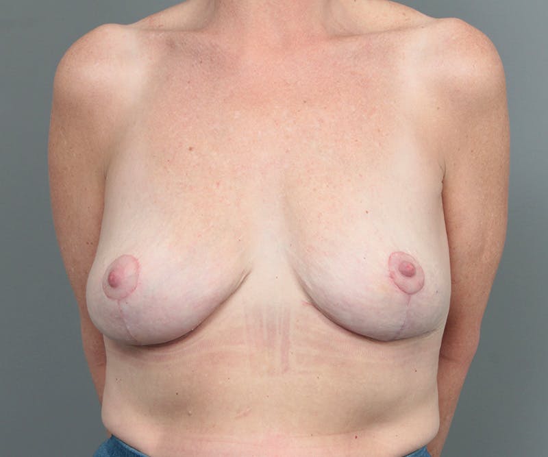 Breast Lift Before & After Gallery - Patient 655979 - Image 2 - Scott Chapin, MD