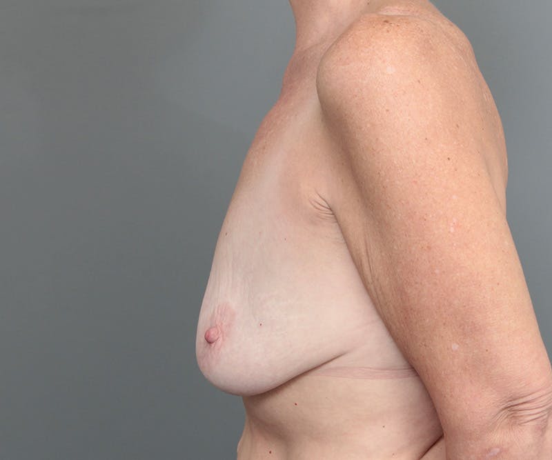 Breast Lift Before & After Gallery - Patient 655979 - Image 5 - Scott Chapin, MD