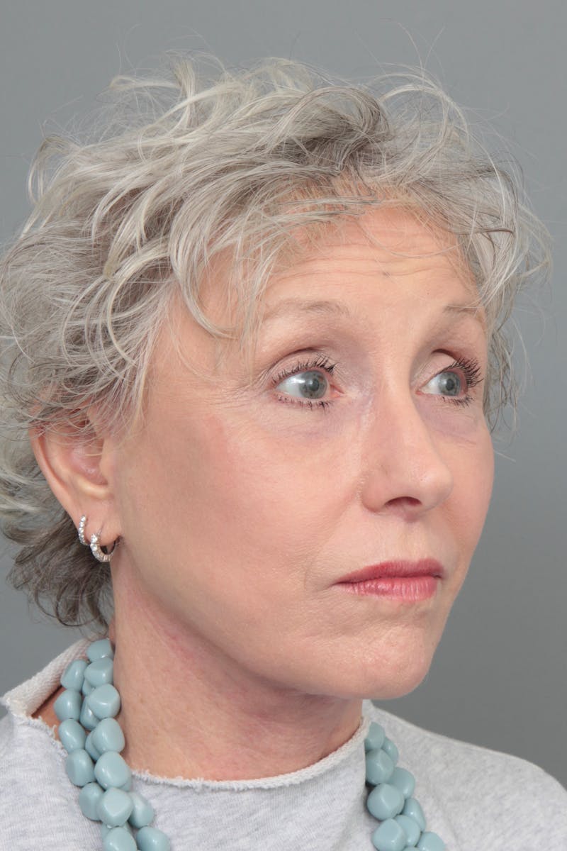 Facelift | Neck Lift Before & After Gallery - Patient 366460 - Image 6 - Scott Chapin, MD