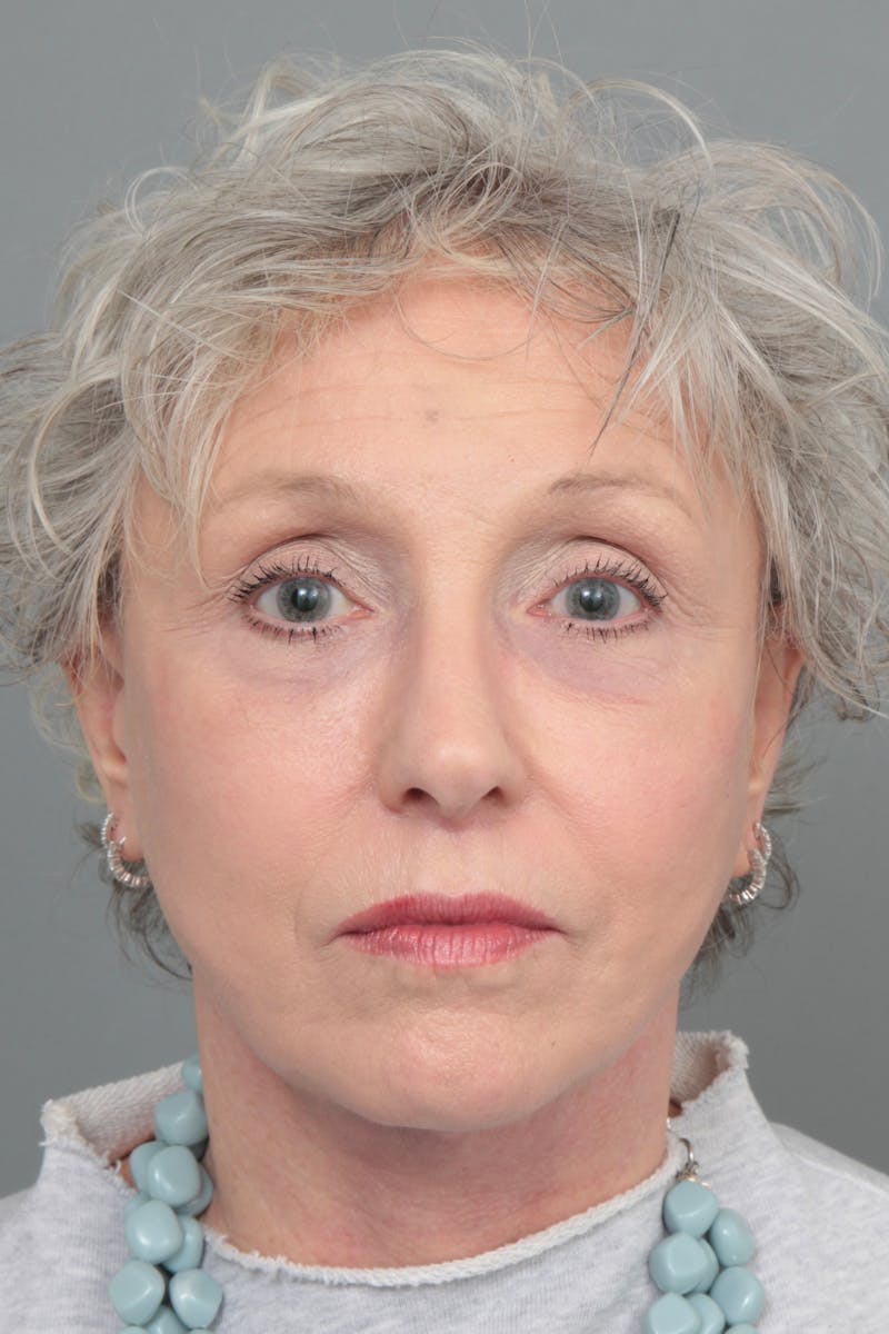 Facelift | Neck Lift Before & After Gallery - Patient 366460 - Image 4 - Scott Chapin, MD