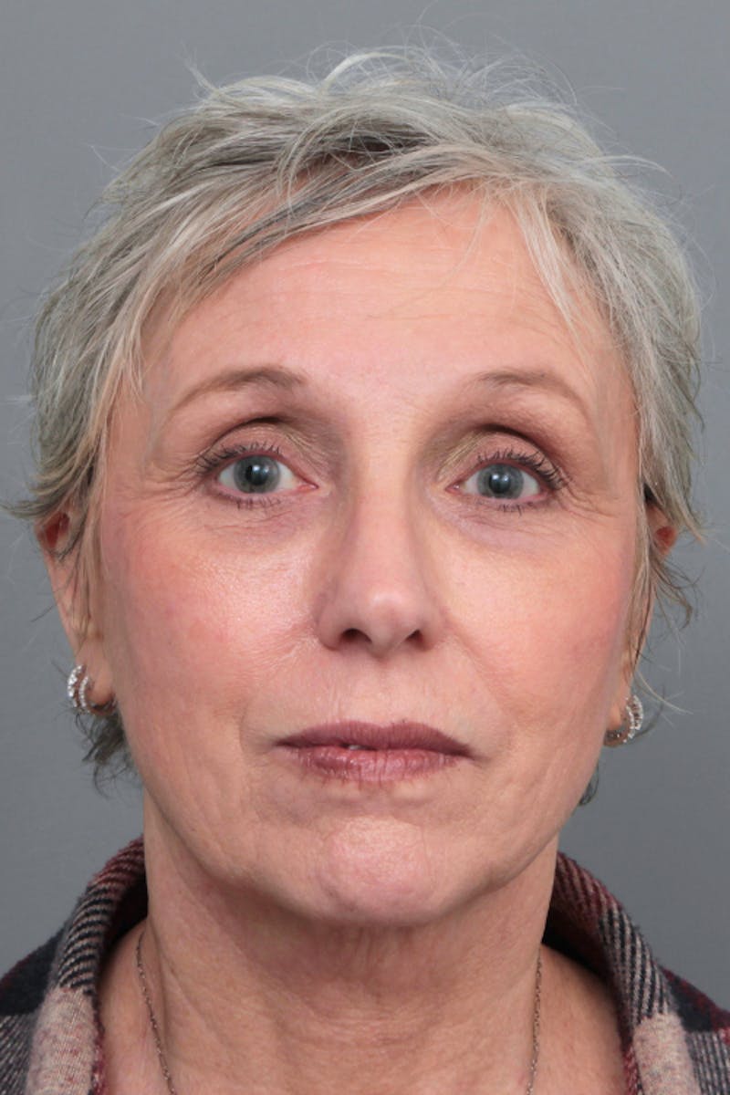 Facelift | Neck Lift Before & After Gallery - Patient 366460 - Image 3 - Scott Chapin, MD
