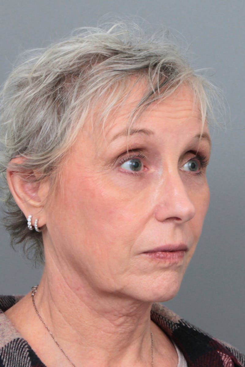 Facelift | Neck Lift Before & After Gallery - Patient 366460 - Image 5 - Scott Chapin, MD