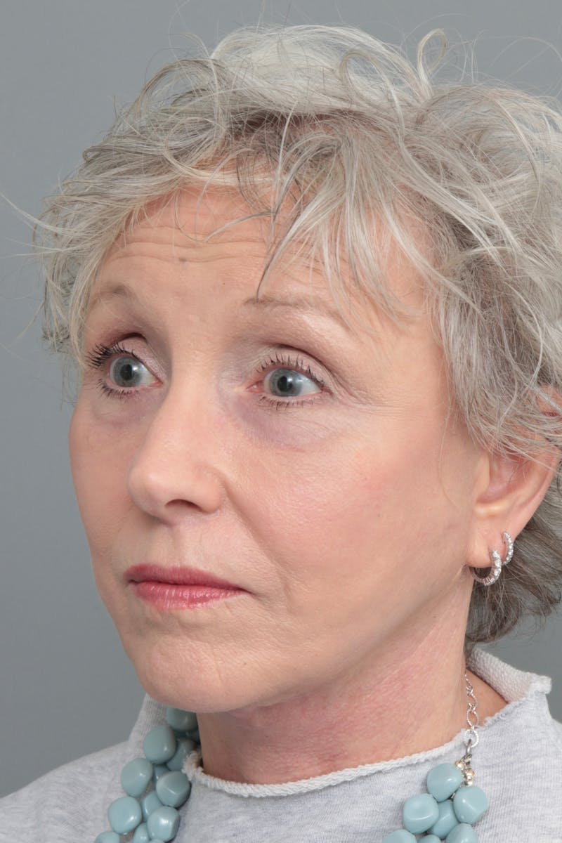 Facelift | Neck Lift Before & After Gallery - Patient 366460 - Image 2 - Scott Chapin, MD