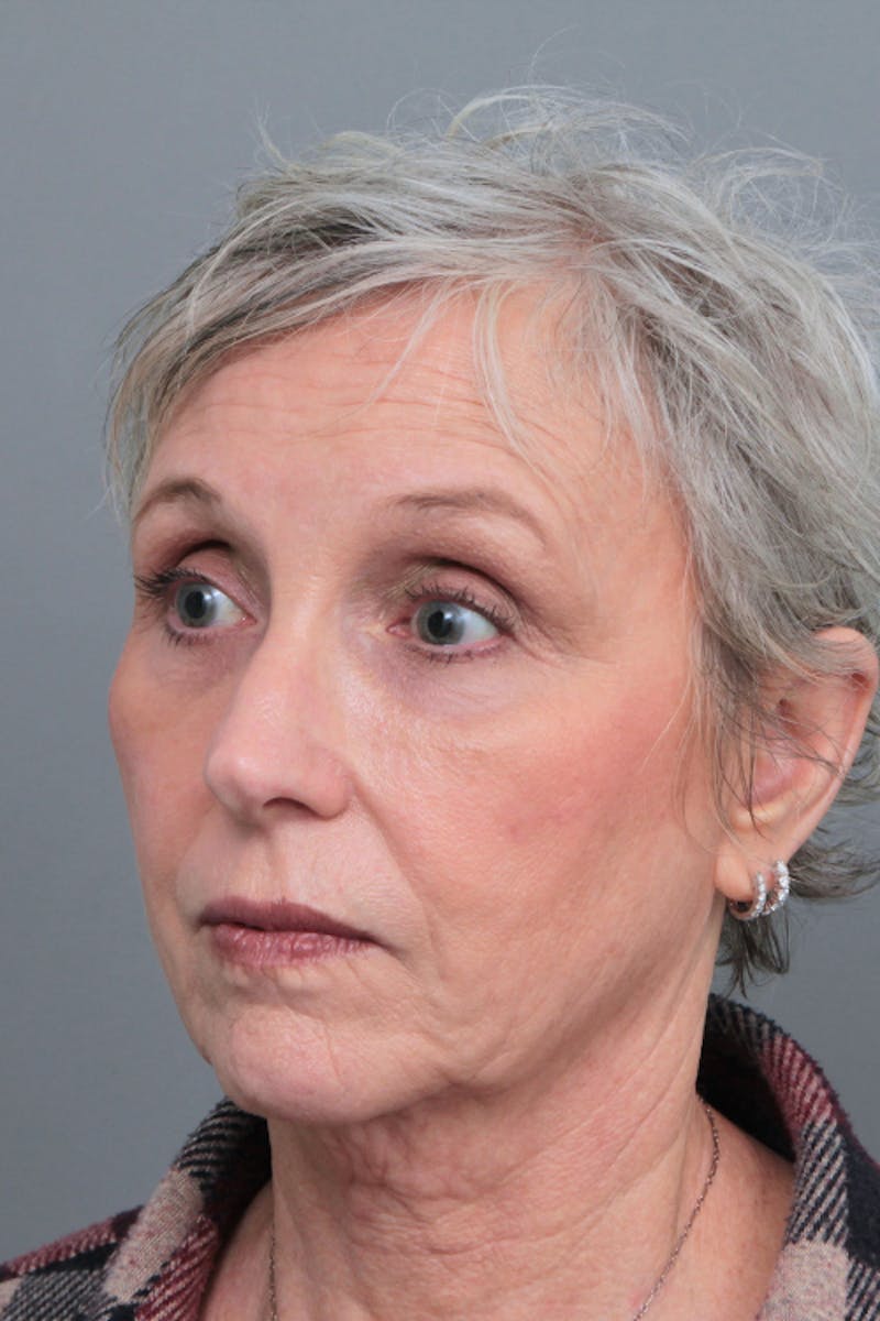 Facelift | Neck Lift Before & After Gallery - Patient 366460 - Image 1 - Scott Chapin, MD