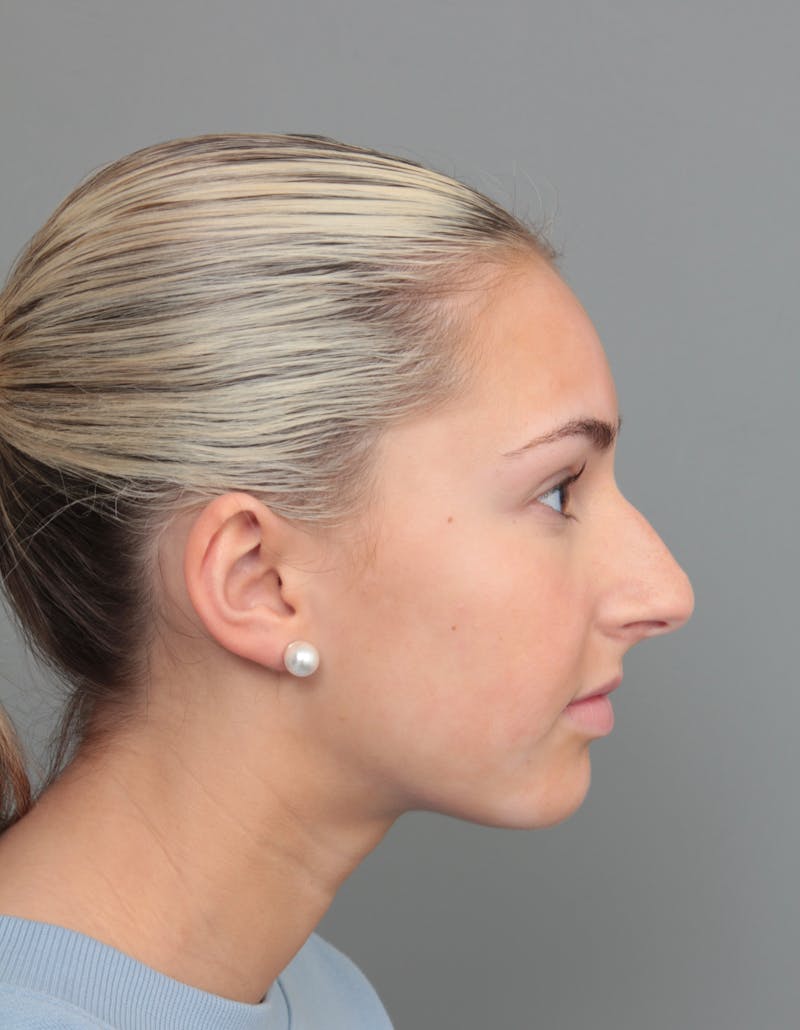 Rhinoplasty Before & After Gallery - Patient 396748 - Image 3 - Scott Chapin, MD