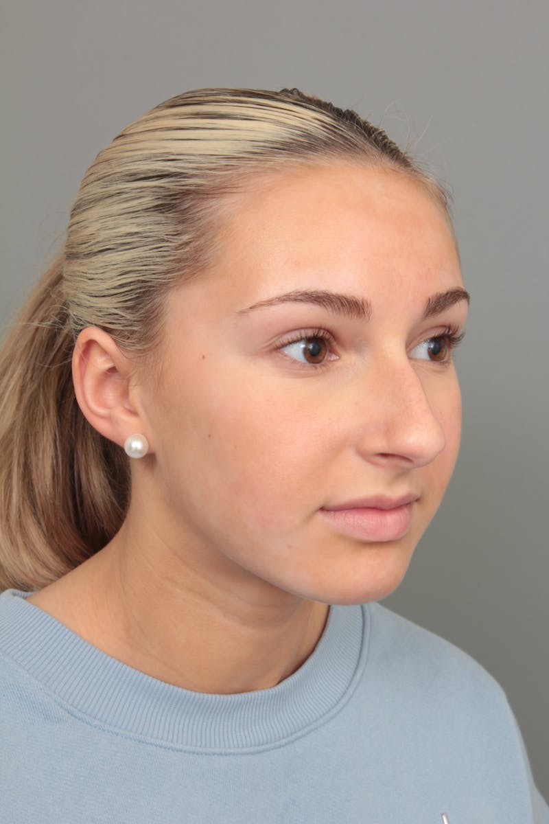 Rhinoplasty Before & After Gallery - Patient 396748 - Image 5 - Scott Chapin, MD