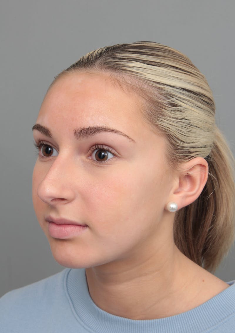 Rhinoplasty Before & After Gallery - Patient 396748 - Image 7 - Scott Chapin, MD