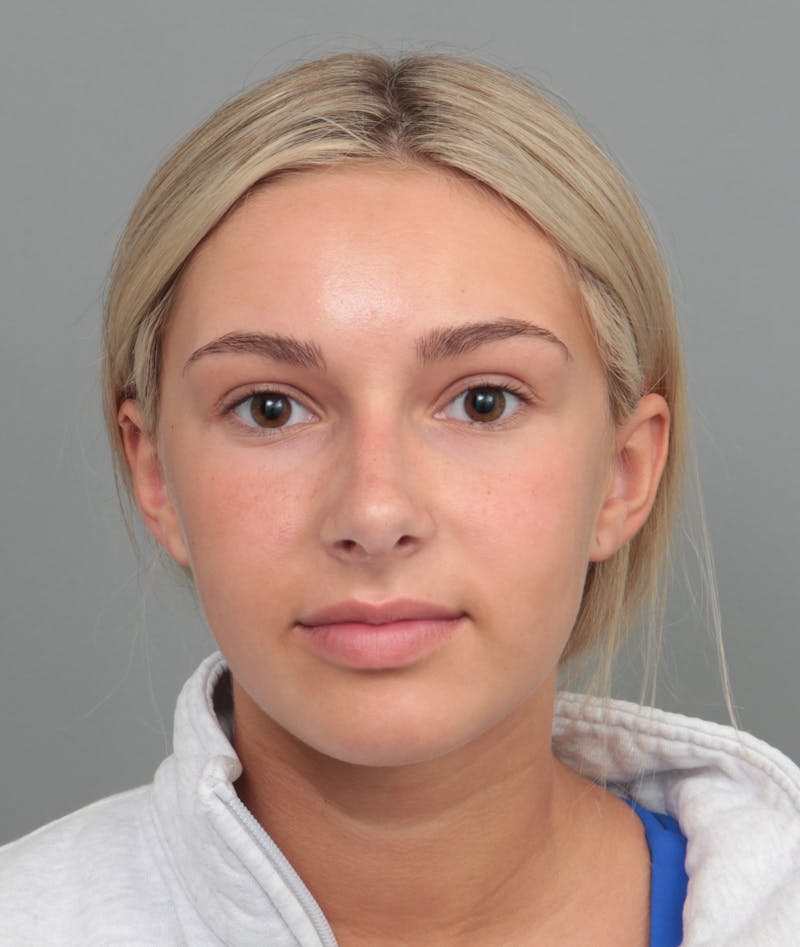 Rhinoplasty Before & After Gallery - Patient 396748 - Image 2 - Scott Chapin, MD