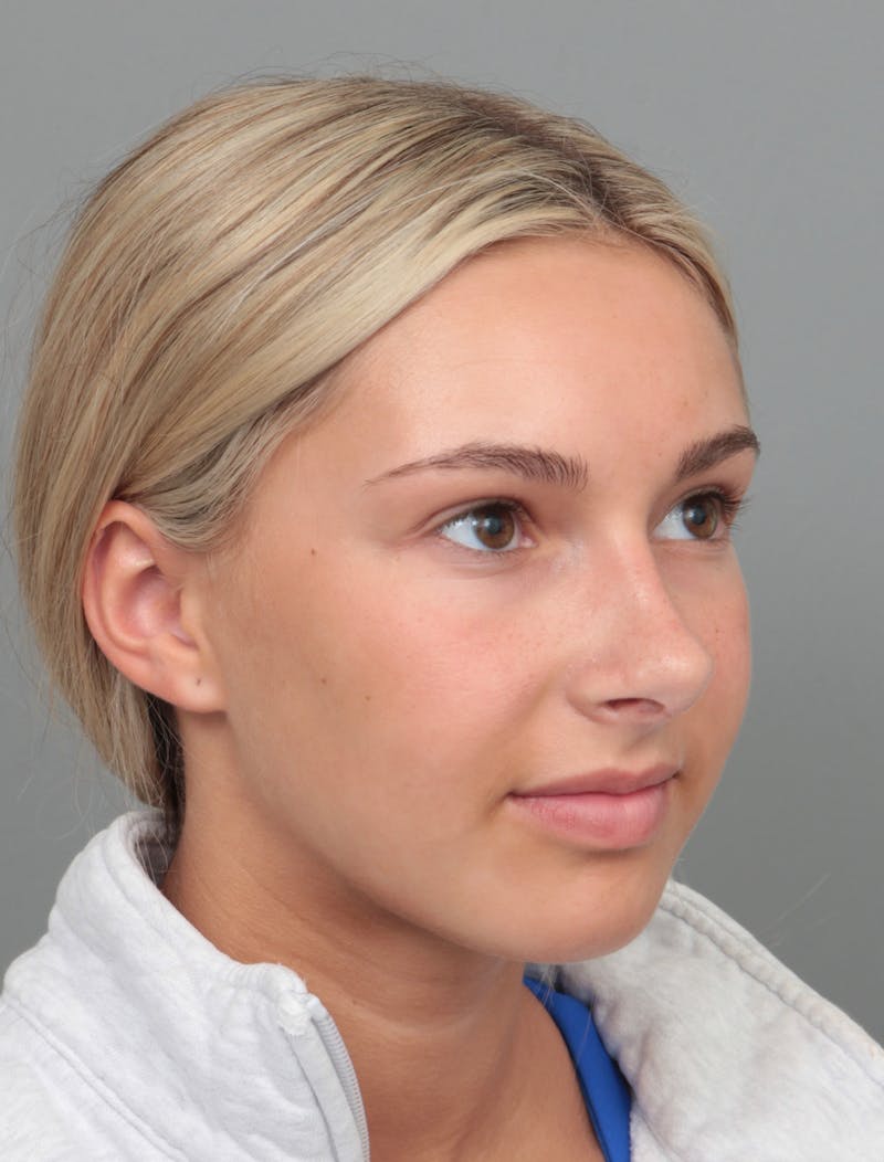 Rhinoplasty Before & After Gallery - Patient 396748 - Image 6 - Scott Chapin, MD