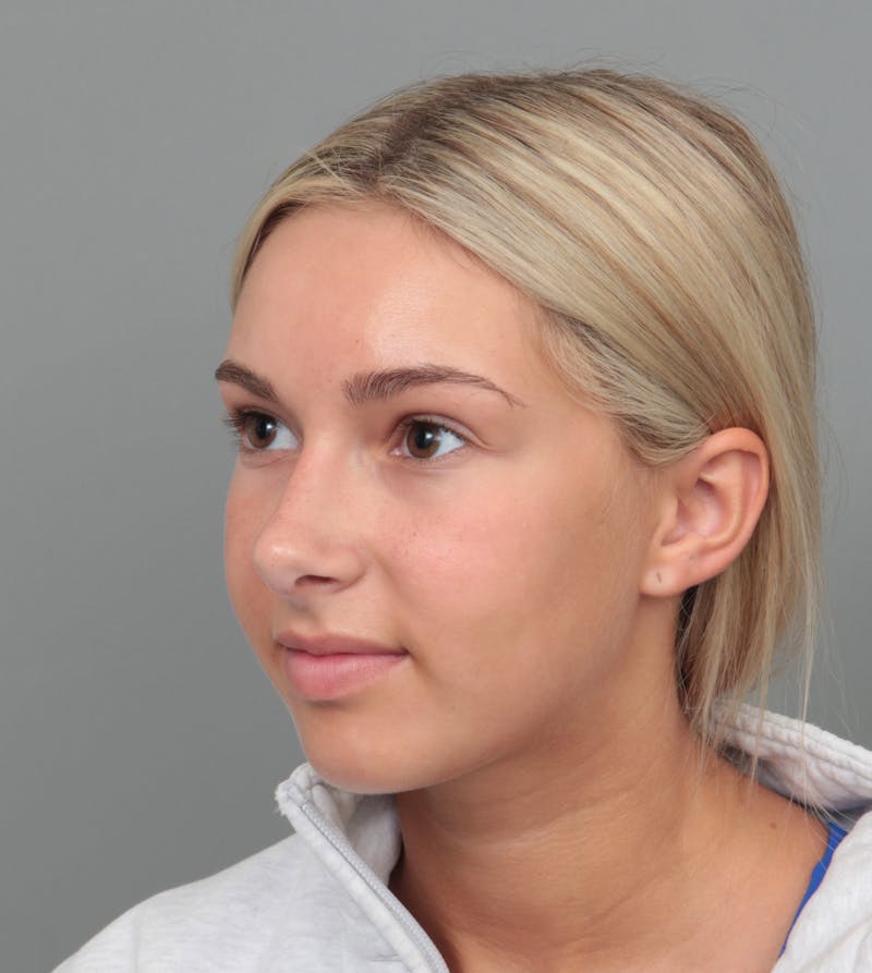 Rhinoplasty Before & After Gallery - Patient 396748 - Image 8 - Scott Chapin, MD