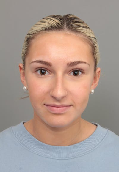 Rhinoplasty Before & After Gallery - Patient 396748 - Image 1 - Scott Chapin, MD