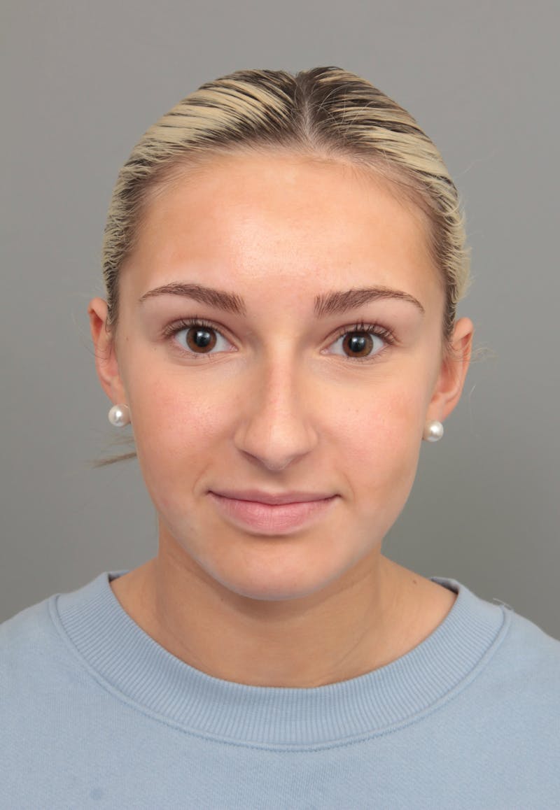 Rhinoplasty Before & After Gallery - Patient 396748 - Image 1 - Scott Chapin, MD