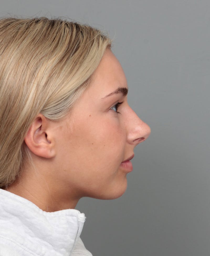 Rhinoplasty Before & After Gallery - Patient 396748 - Image 4 - Scott Chapin, MD
