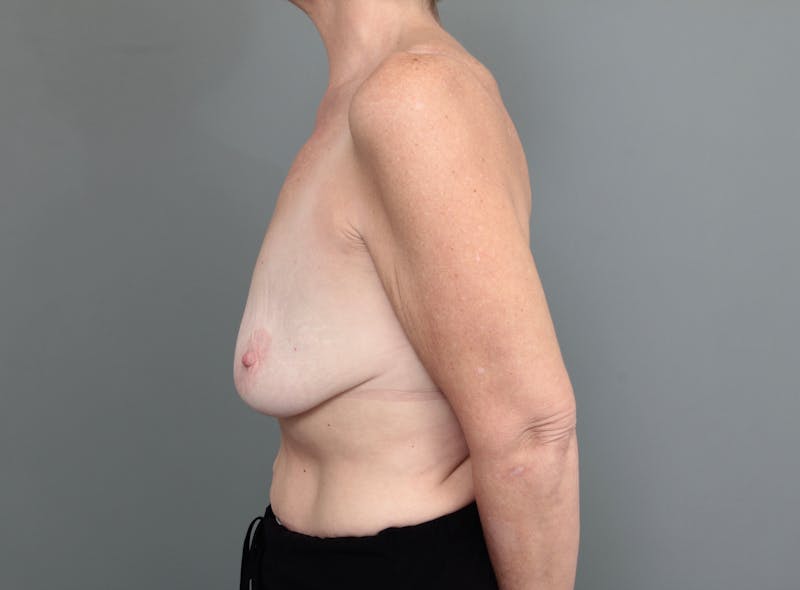 Breast Lift with Augmentation Before & After Gallery - Patient 418466 - Image 5 - Scott Chapin, MD