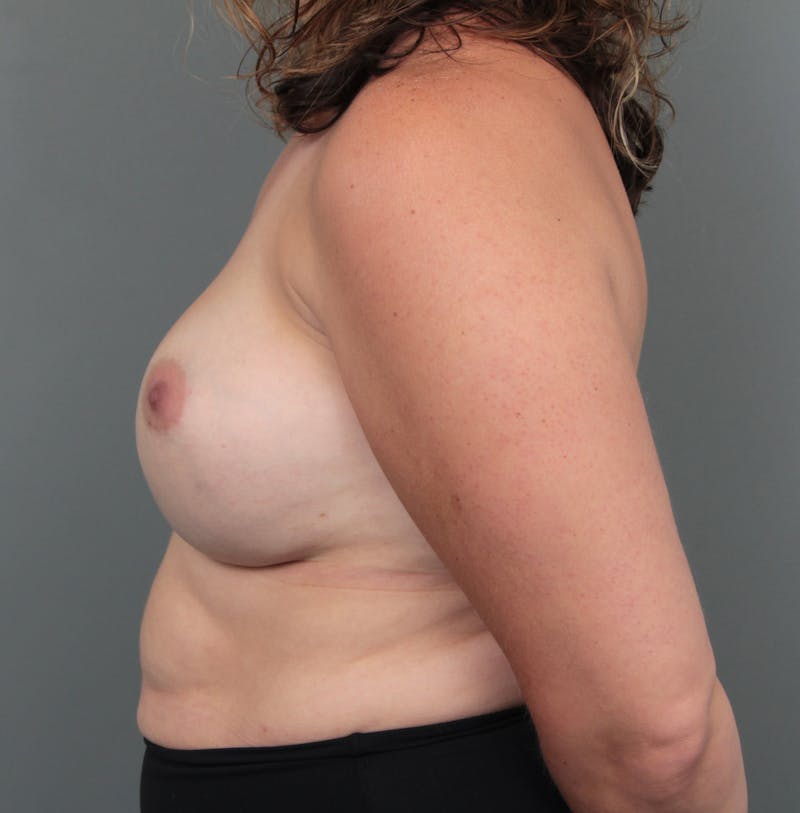 Breast Augmentation Before & After Gallery - Patient 996117 - Image 5 - Scott Chapin, MD