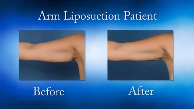 arm liposuction side by side