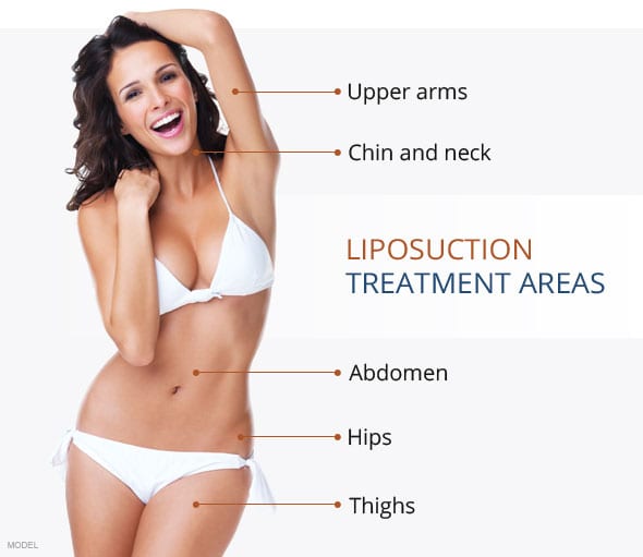 Liposuction Diagram