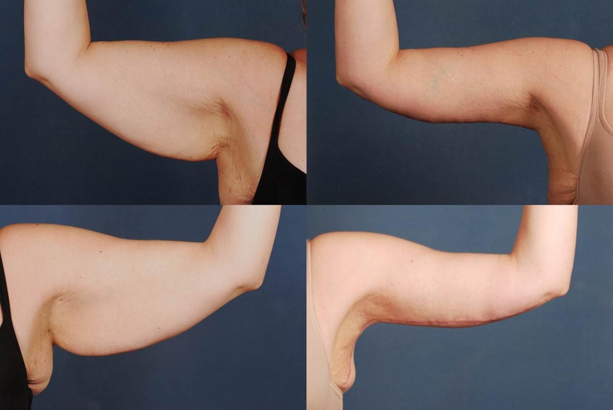 Arm Lift Before & After Gallery - Patient 204389 - Image 1