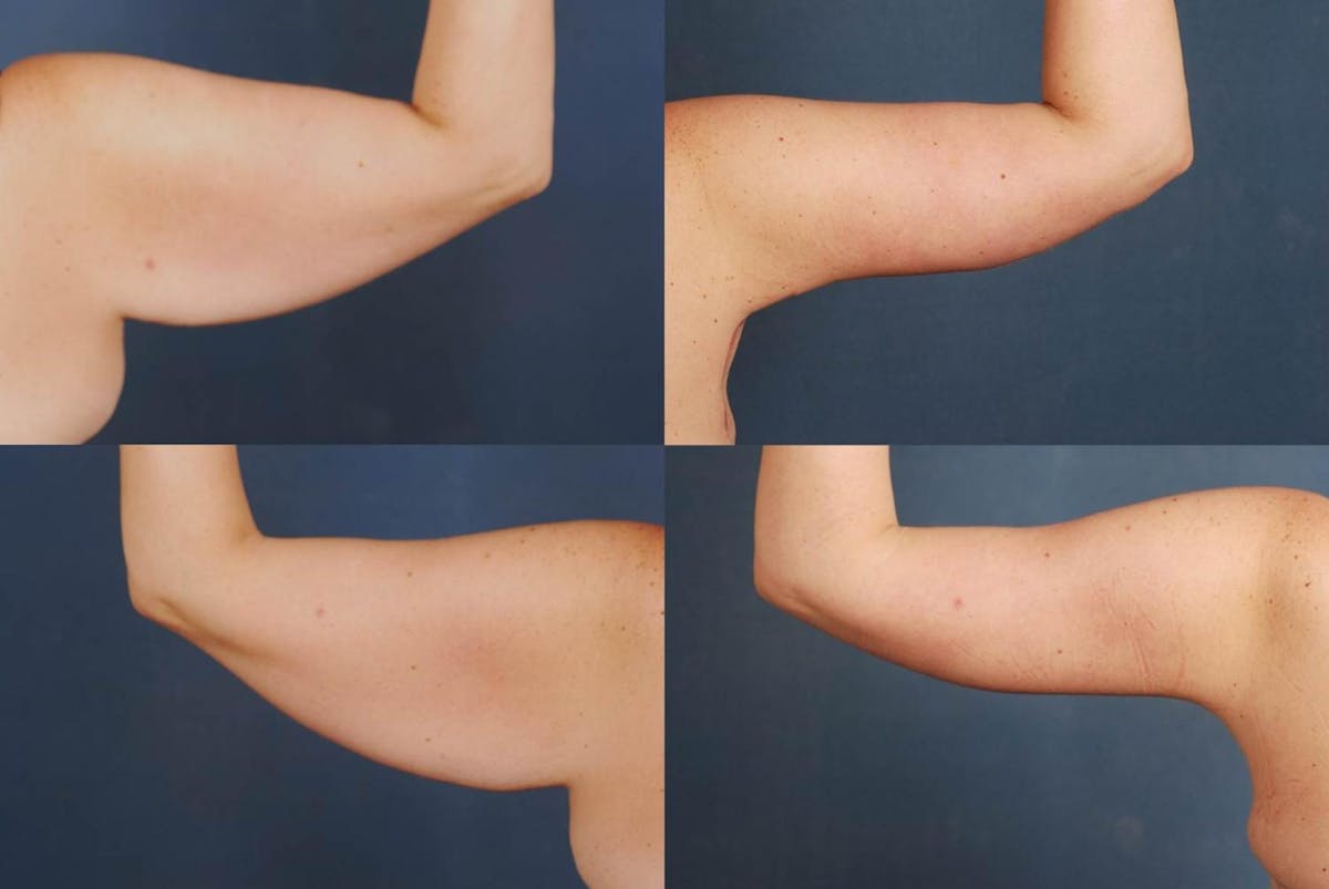 Arm Lift Before & After Gallery - Patient 204389 - Image 2
