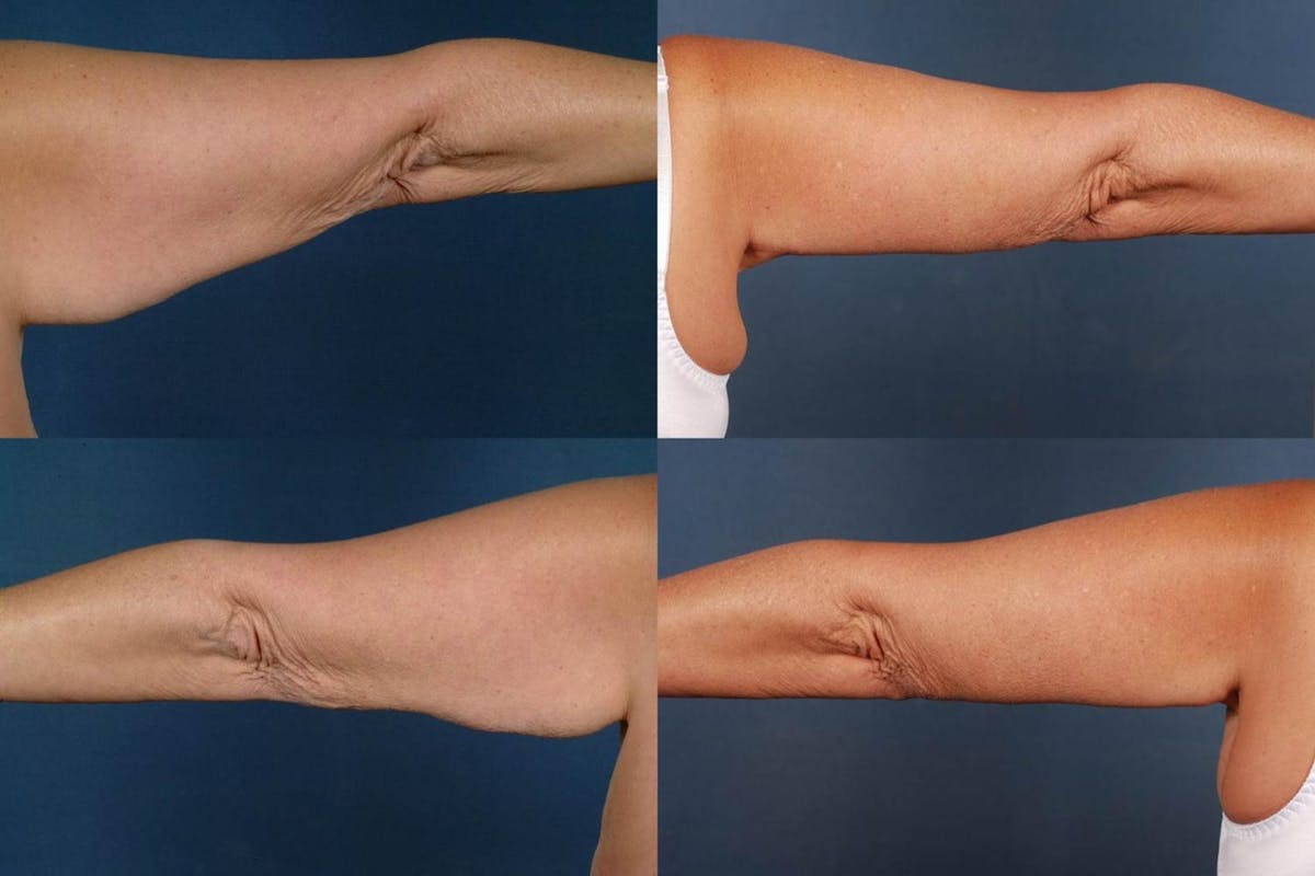 Arm Lift Before & After Gallery - Patient 166779 - Image 2