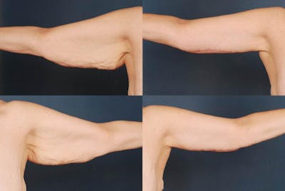 Arm Lift Before & After Gallery - Patient 367498 - Image 1