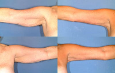 Arm Lift Before & After Gallery - Patient 296289 - Image 1