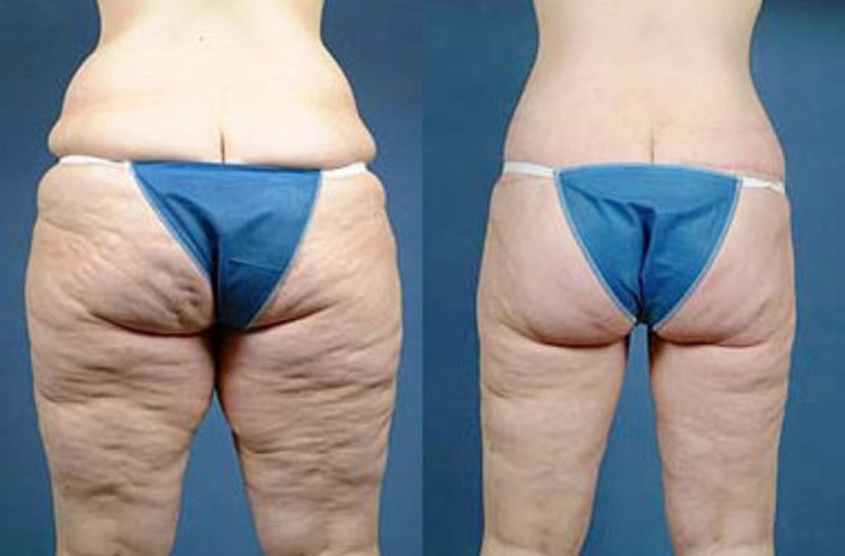 Body/Thigh Lift Before & After Gallery - Patient 105327 - Image 2