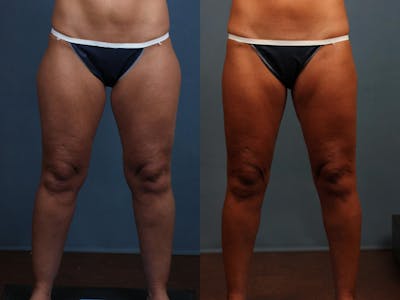 Body/Thigh Lift Before & After Gallery - Patient 288601 - Image 1