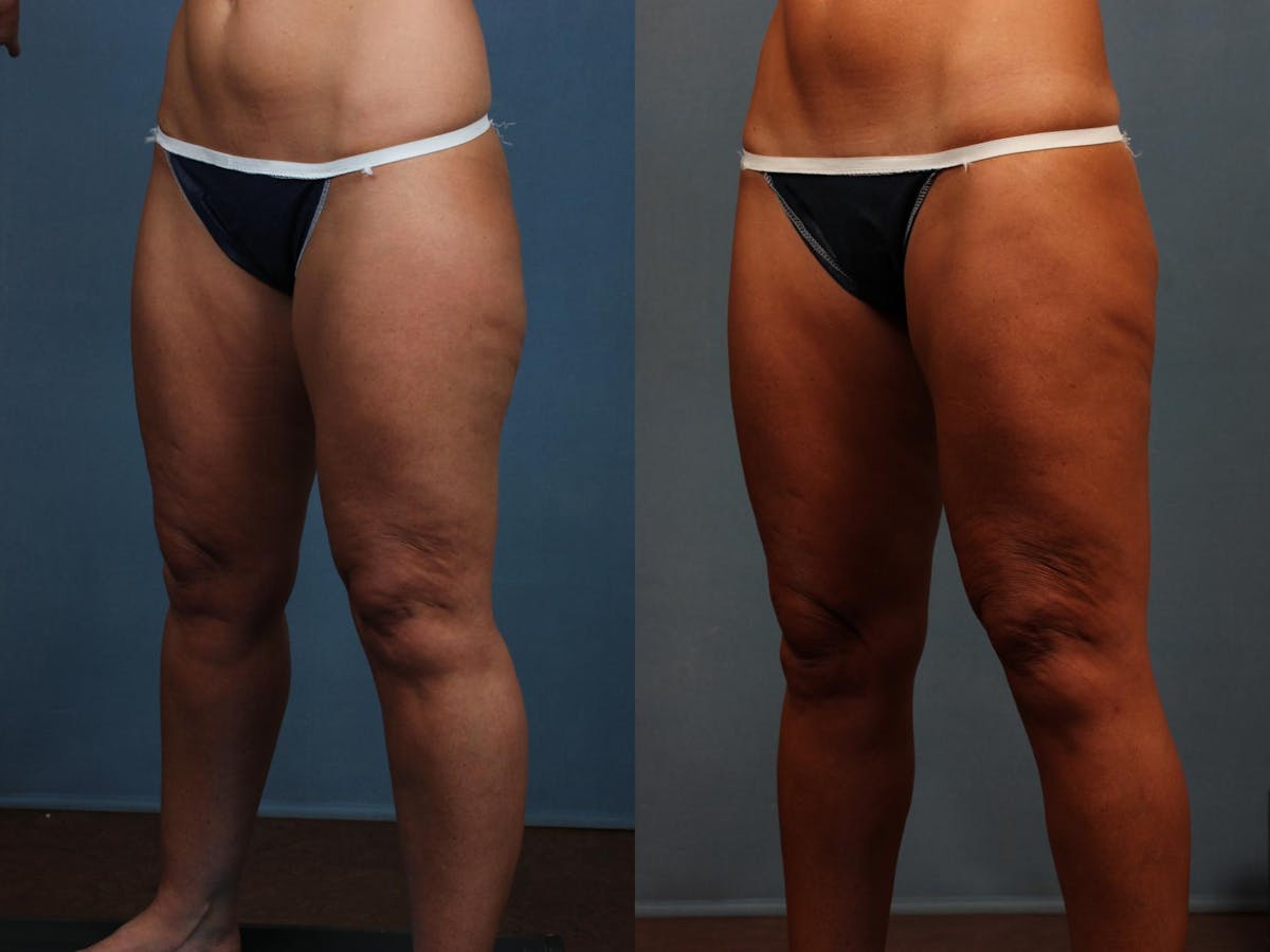 Body/Thigh Lift Before & After Gallery - Patient 288601 - Image 2