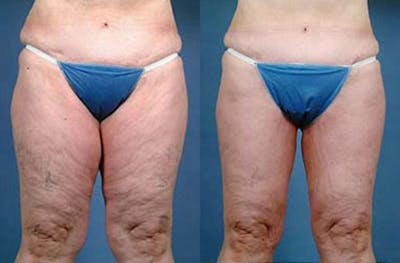 Body/Thigh Lift Before & After Gallery - Patient 558041 - Image 1