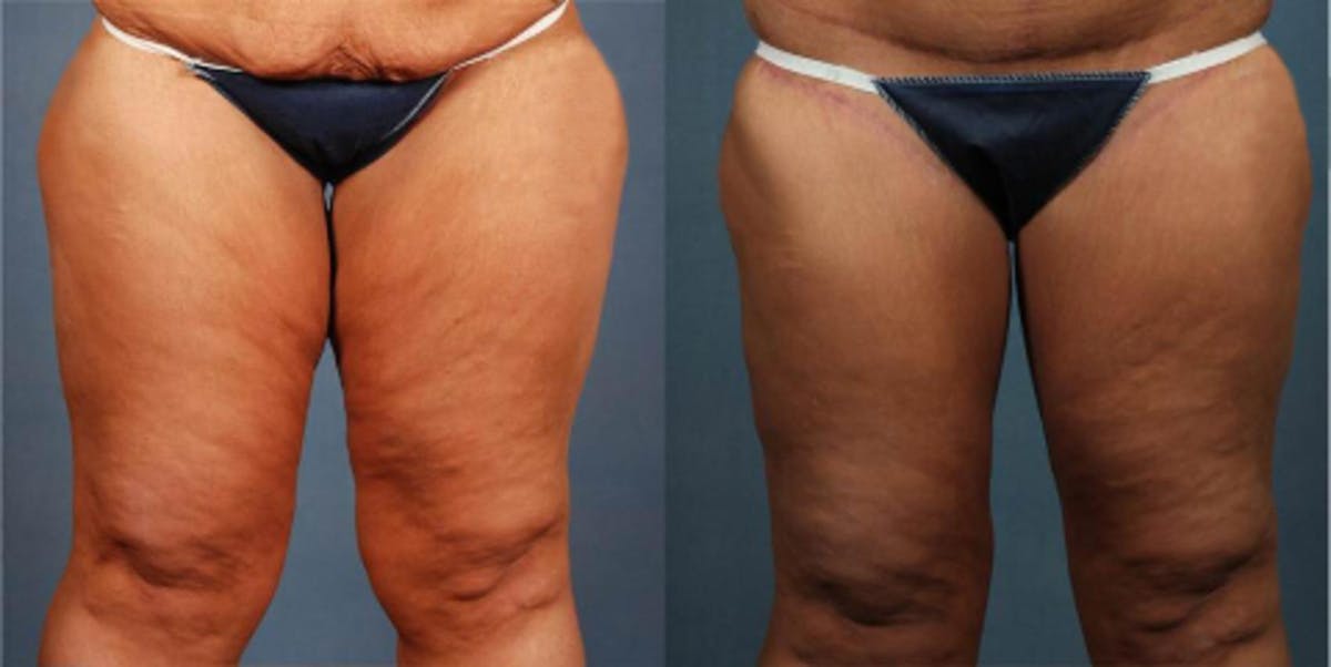 Body/Thigh Lift Before & After Gallery - Patient 172026 - Image 1