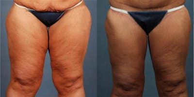 Body/Thigh Lift Before & After Gallery - Patient 172026 - Image 1