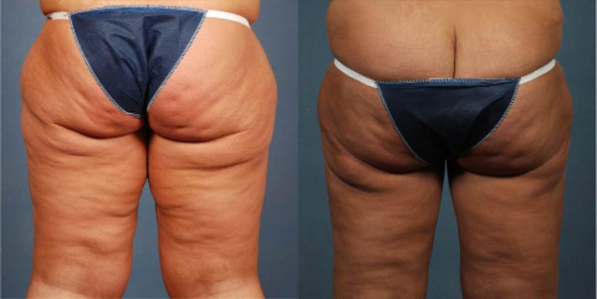 Body/Thigh Lift Before & After Gallery - Patient 172026 - Image 2