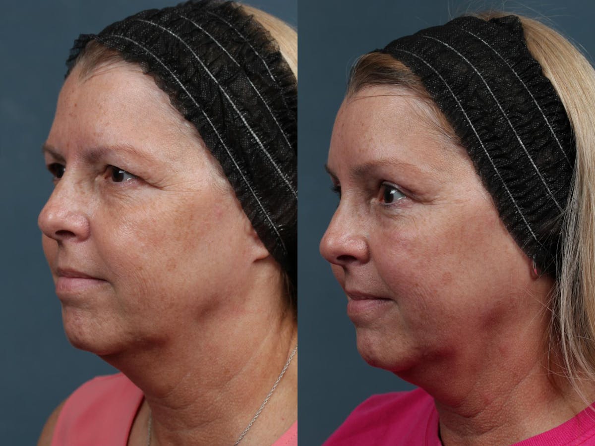Brow/Forehead Lift Before & After Gallery - Patient 412263 - Image 2