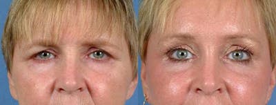 Brow/Forehead Lift Before & After Gallery - Patient 366636 - Image 1