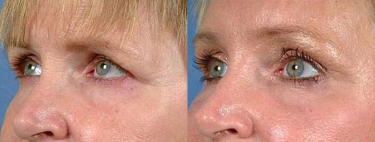 Brow/Forehead Lift Before & After Gallery - Patient 366636 - Image 2