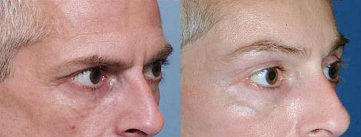 Brow/Forehead Lift Before & After Gallery - Patient 395545 - Image 2