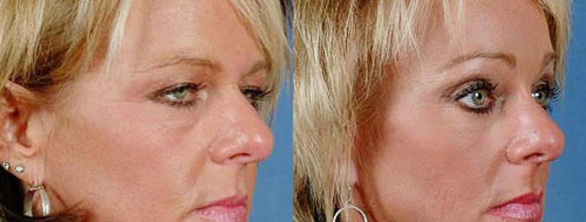 Brow/Forehead Lift Before & After Gallery - Patient 340447 - Image 2