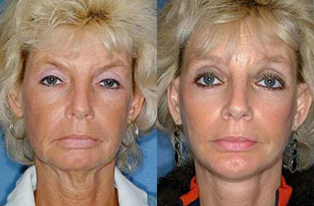 Brow/Forehead Lift Before & After Gallery - Patient 201186 - Image 1