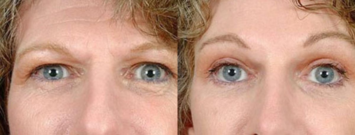 Brow/Forehead Lift Before & After Gallery - Patient 380326 - Image 1