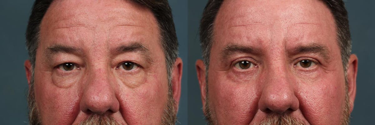 Blepharoplasty Before & After Gallery - Patient 258789 - Image 1