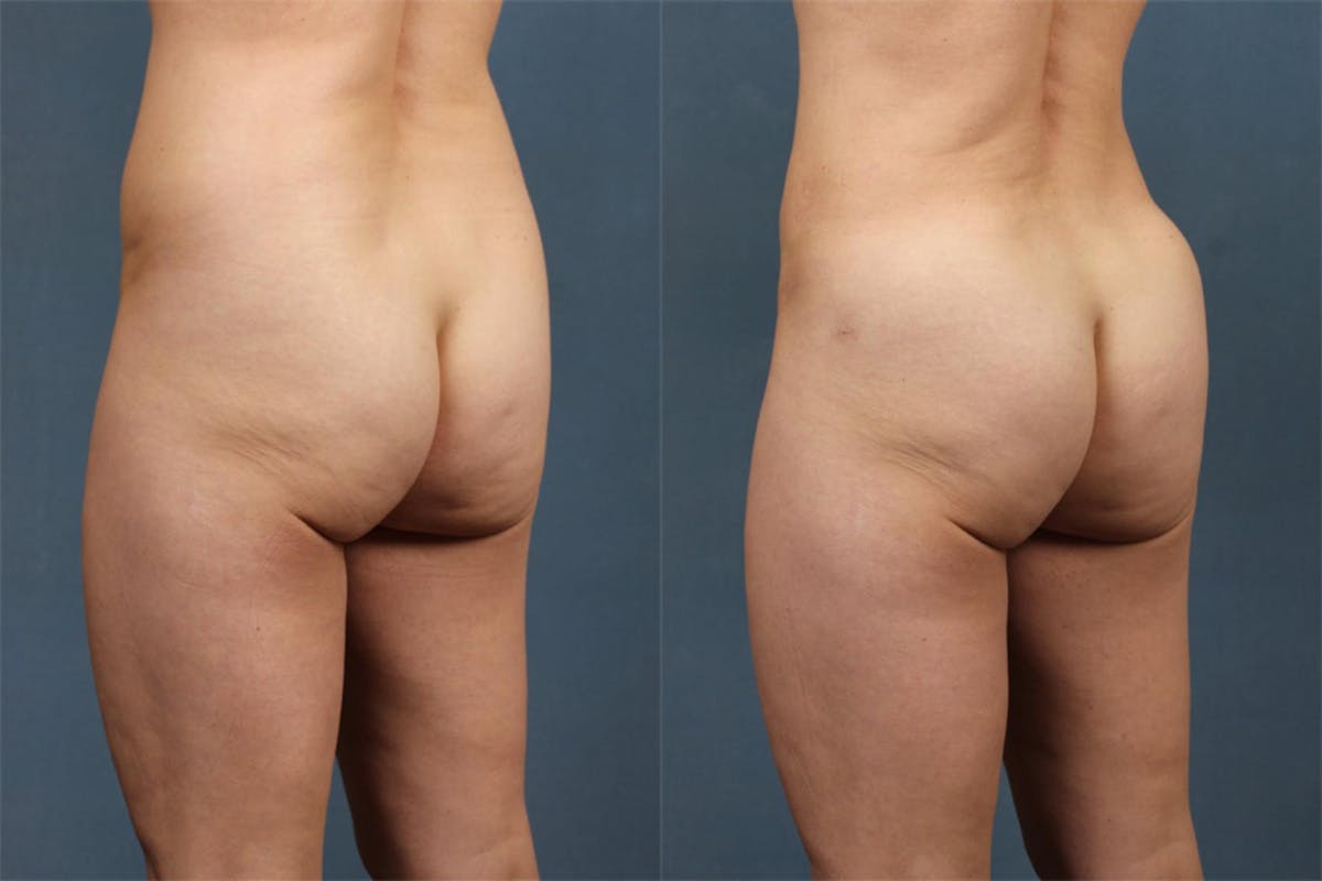 Fat Transfer Before & After Gallery - Patient 318302 - Image 2