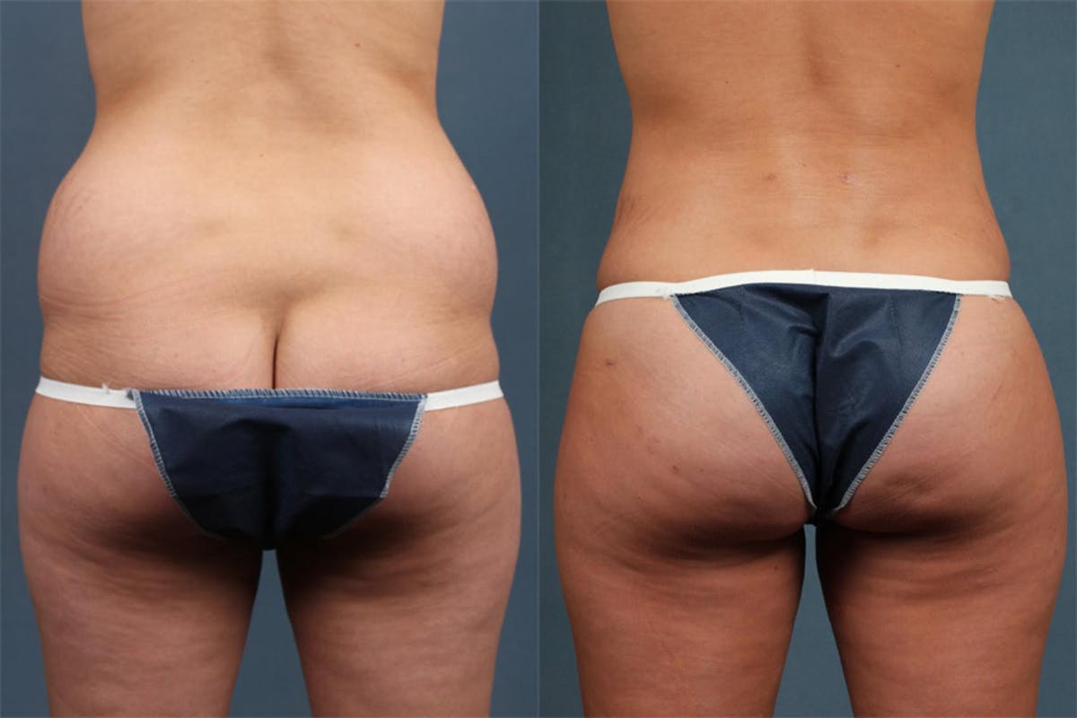 Fat Transfer Before & After Gallery - Patient 583458 - Image 1