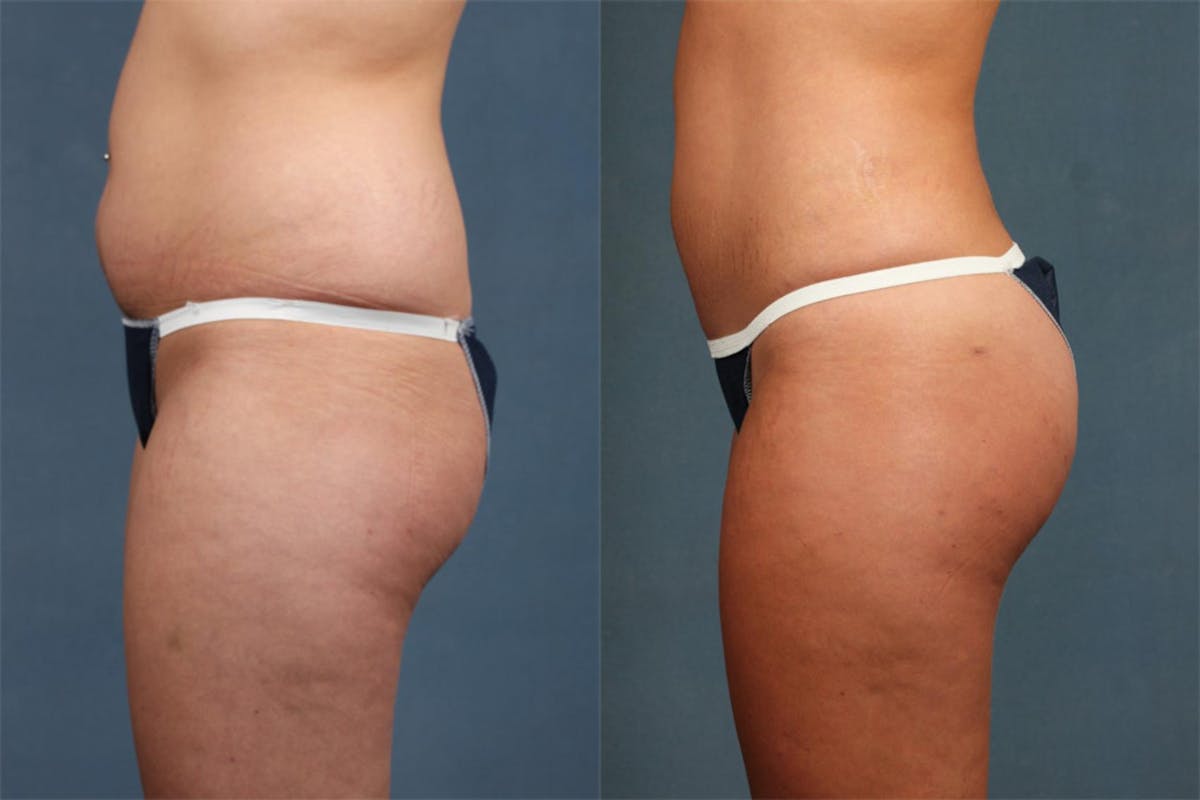 Fat Transfer Before & After Gallery - Patient 583458 - Image 3