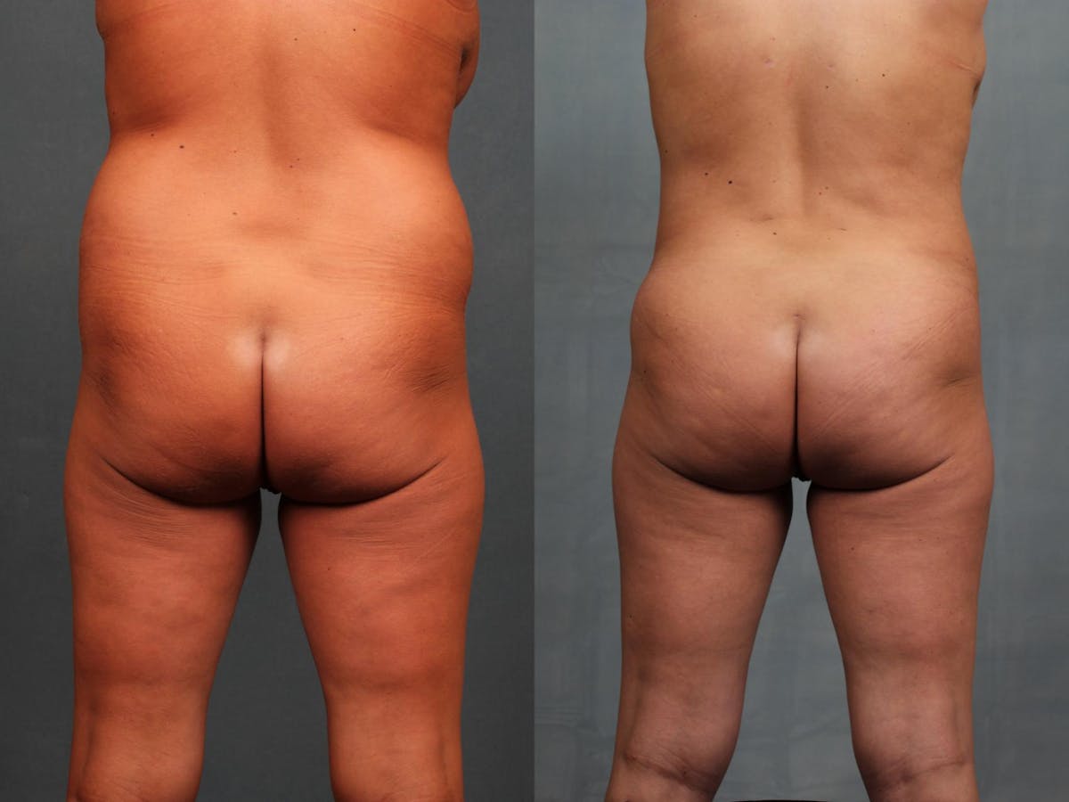 Brazilian Butt Lift Before & After Gallery - Patient 361163 - Image 1