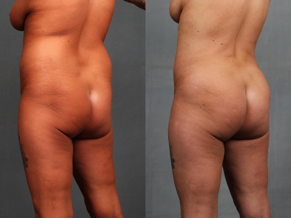 Brazilian Butt Lift Before & After Gallery - Patient 361163 - Image 3