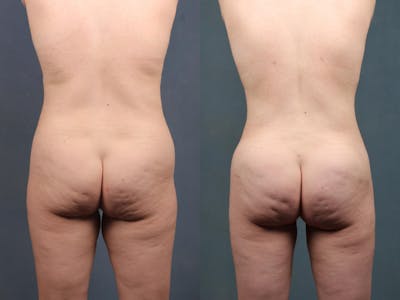 Brazilian Butt Lift Before & After Gallery - Patient 182025 - Image 1