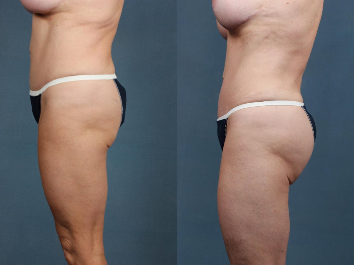 Brazilian Butt Lift Before & After Gallery - Patient 232331 - Image 2